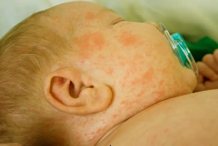 Rôm sảy thường gây ngứa ngáy cho bé