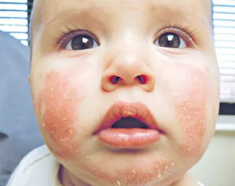 benh-tram-sua-o-tre-nho