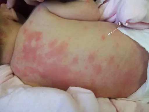 Trẻ nổi ban đỏ khắp người có thể kèm theo triệu chứng sốt cao