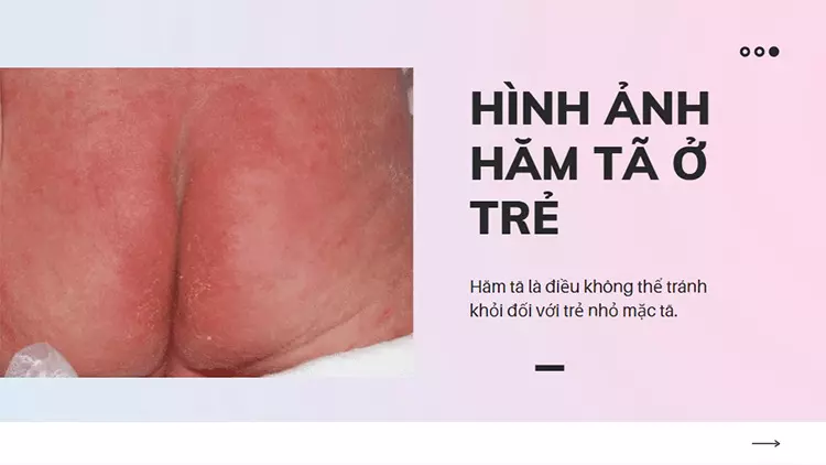 trieu-chung-ham-ta-o-tre-so-sinh