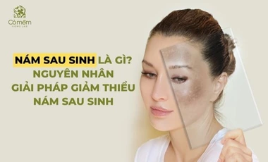 Nám Sau Sinh Là Gì? Nguyên Nhân, Giải Pháp Giảm Thiểu Nám Da Sau Sinh
