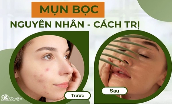 trị mụn bọc