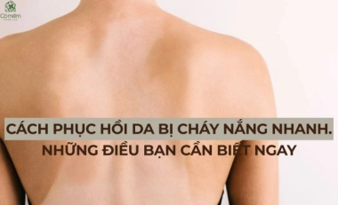 Cách Phục Hồi Da Bị Cháy Nắng Nhanh. Những Điều Bạn Cần Biết Ngay