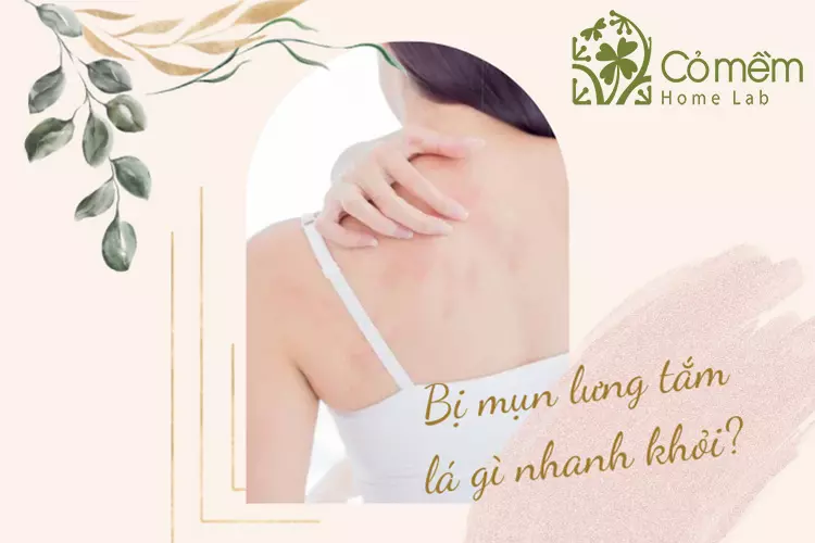 Bị mụn lưng tắm lá gì nhanh khỏi?