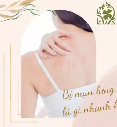 Bị mụn lưng tắm lá gì để làm sạch da và dịu vùng viêm?