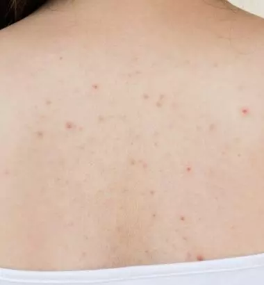 Nổi nhiều MỤN Ở LƯNG là bệnh gì?
