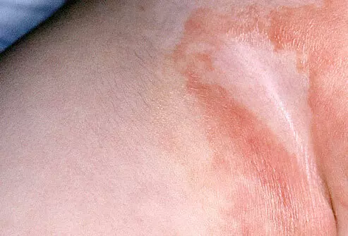 Trẻ sơ sinh bị mẩn ngứa - nguyên nhân là do đâu?