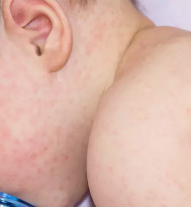 Tiết lộ 6 loại lá mẹ nên nấu nước tắm cho bé khi bị sởi