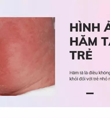Hăm tã ở trẻ sơ sinh - mẹ nên xử lý thế nào?