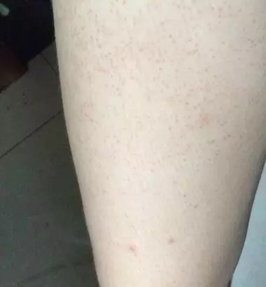 Làm sao để không bị viêm lỗ chân lông vào mùa đông