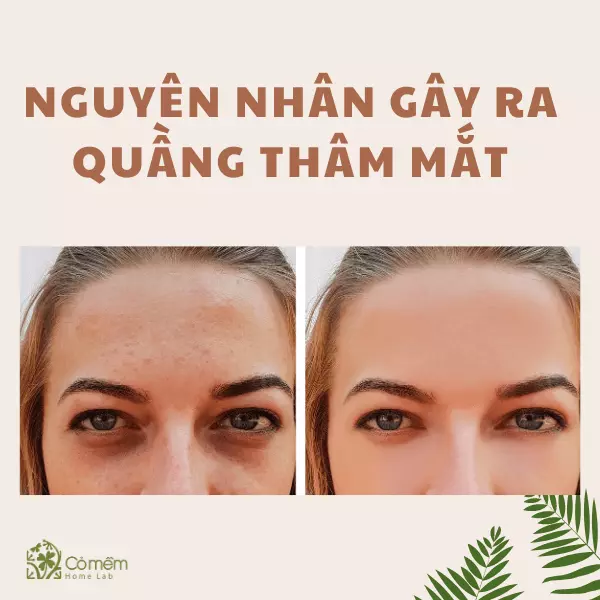 kem trị thâm mắt