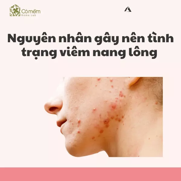 nguyên nhân gây viêm nang lông