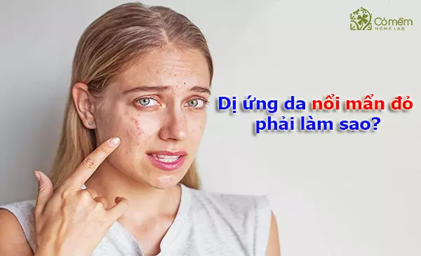 bị dị ứng da nổi mẩn đỏ