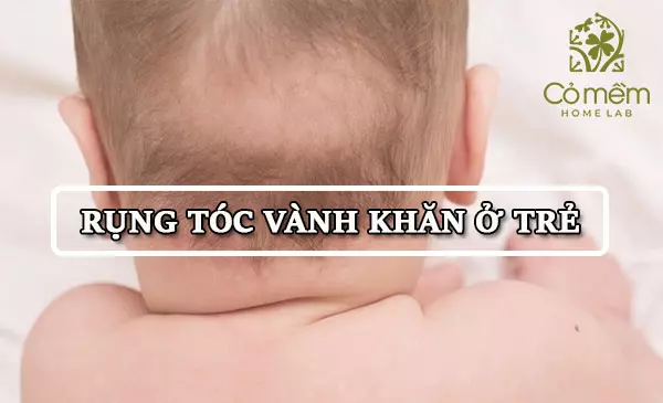 rụng tóc vành khăn