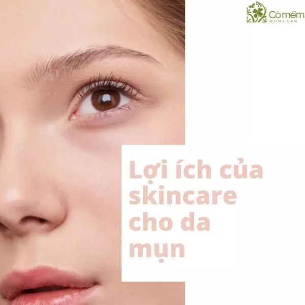 skincare cho da mụn