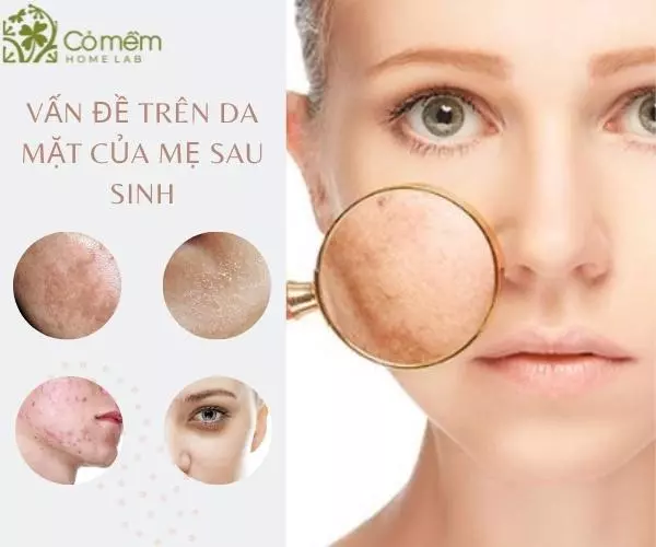 7+ Bí Quyết Chăm Sóc Da Mặt Sau Sinh Đẹp Như Thời Còn Đôi Mươi Cho Mẹ Bỉm