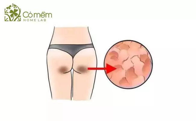Mách Bạn 3 Cách Tẩy Tế Bào Chết Cho Mông Đơn Giản - Hiệu Quả