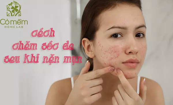 07 Bước skincare sau khi nặn mụn an toàn cho "mọi loại da"