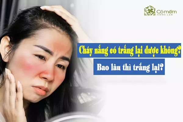 cách làm dịu da cháy nắng