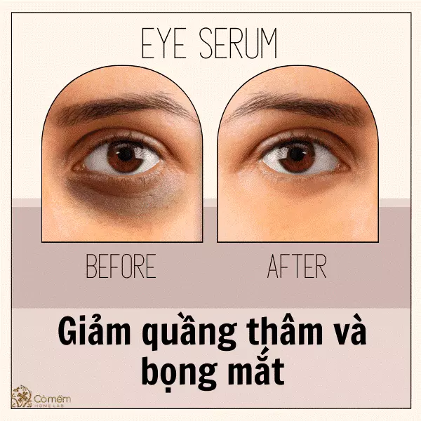 Giảm quầng thâm và bọng mắt 