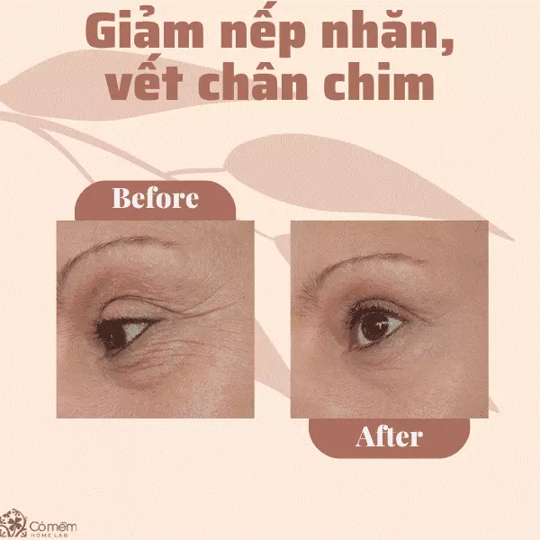 Giảm nếp nhăn, vết chân chim 