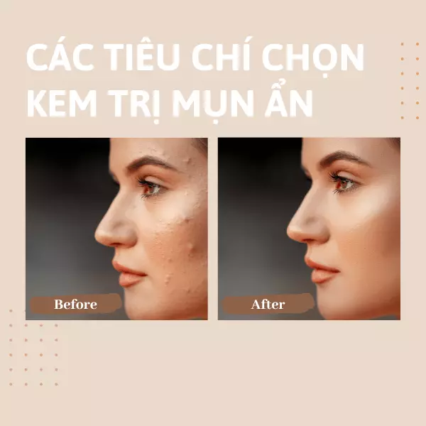 kem trị mụn ẩn cho da dầu