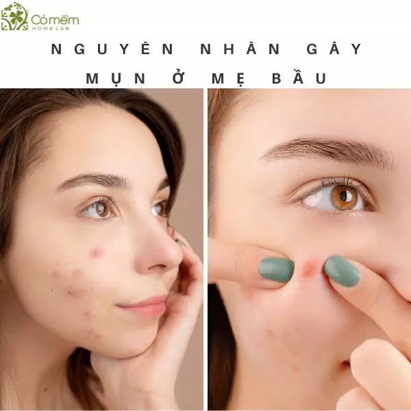 kem trị mụn cho bà bầu