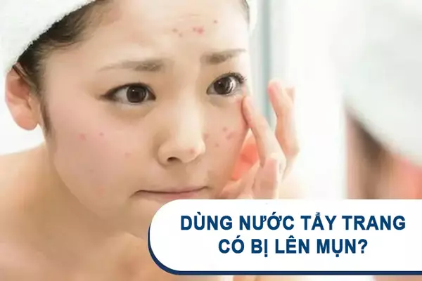 Có nên dùng nước tẩy trang khi bị da mụn