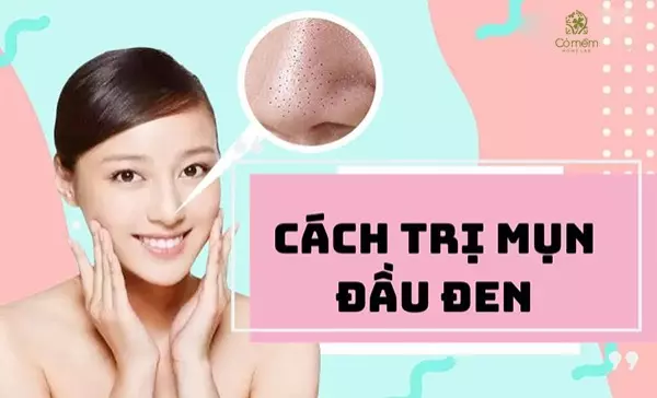 cách trị mụn đầu đen