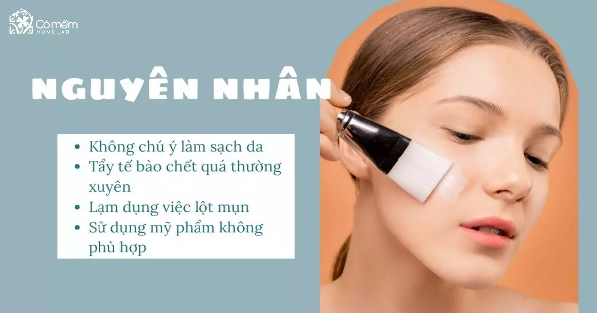 cách trị mụn đầu đen