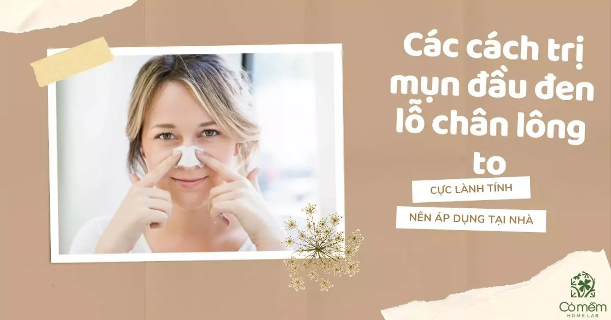 cách trị mụn đầu đen và lỗ chân lông to