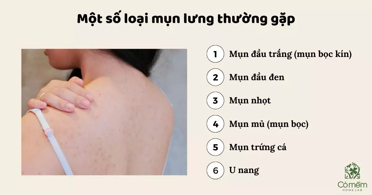 trị mụn lưng