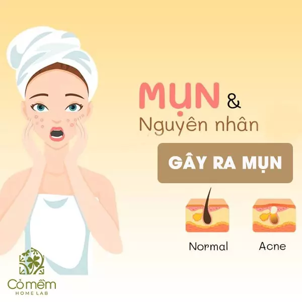 trị mụn trứng cá